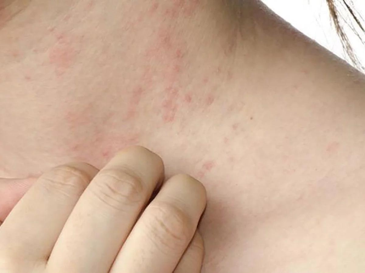 dermatitis por perfumes tratamiento - Qué hacer para que desaparezca la dermatitis